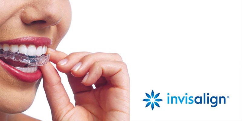 Paciente con alineador transparente Invisalign